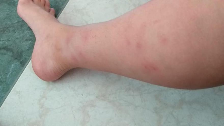 las picaduras de mosquito