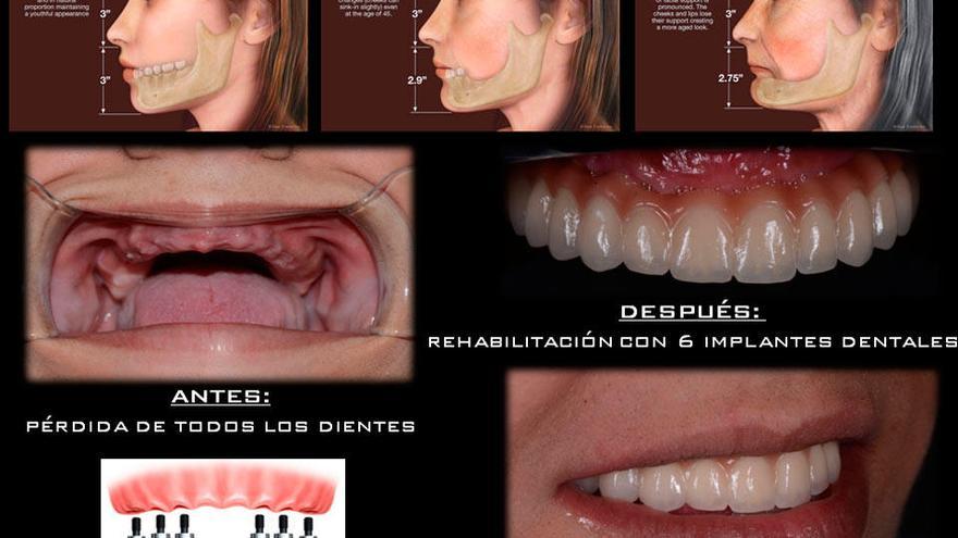 Tratamientos dentales que rejuvenecen