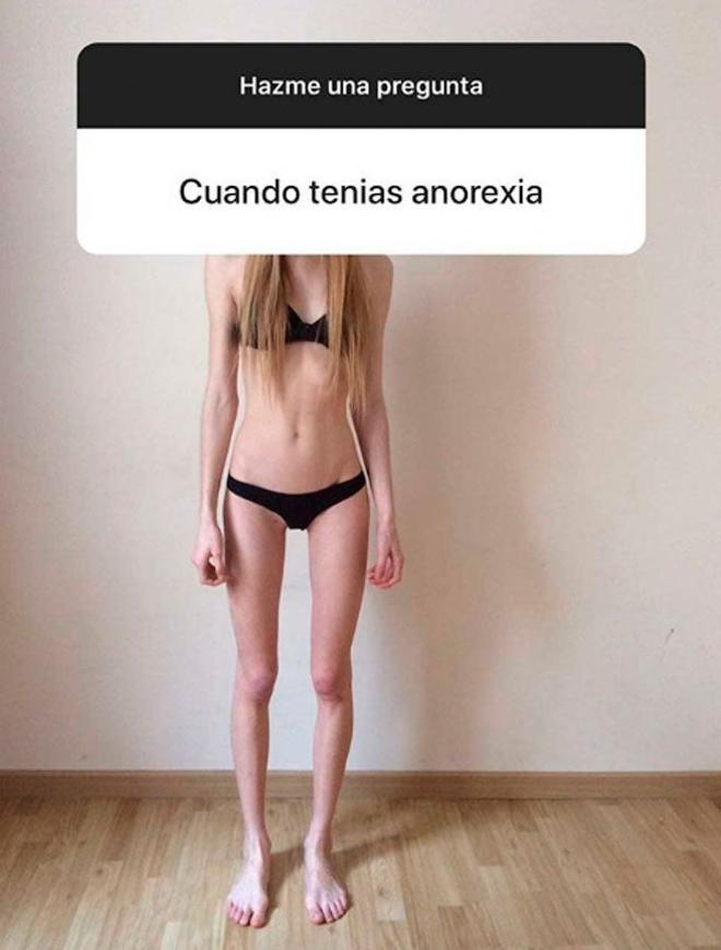 Marta López Álamo, foto antigua, de cuando sufría anorexia