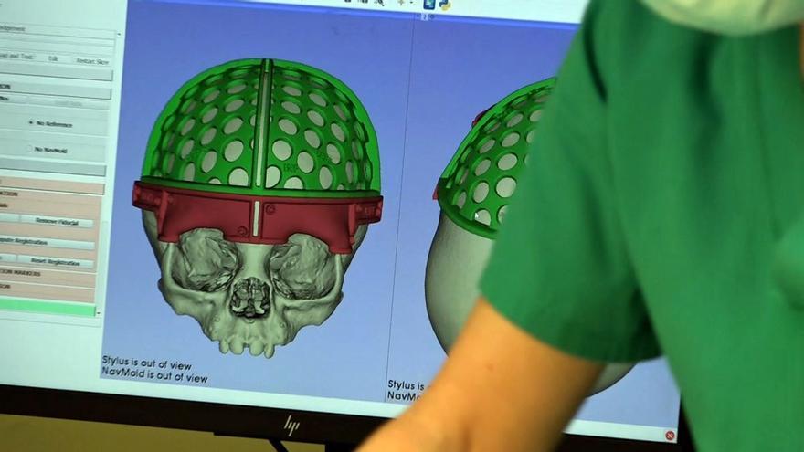 Una tecnología quirúrgica pionera en el mundo para tratar malformaciones cráneo-faciales en bebés