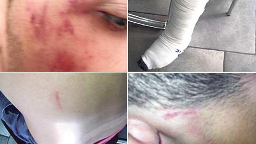 Imágenes de las lesiones sufridas por los adolescentes, según su versión causadas por los golpes propinados por los policías que los detuvieron.