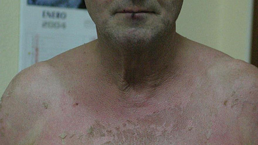 Quemaduras sufridas por el paciente tras recibir un tratamiento de puvaterapia.