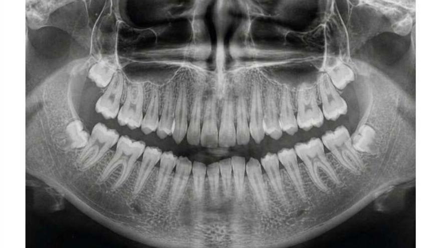 Ein "Nanoknochen" aus biologisch abbaubarem Material ermöglicht dem Körper Knochenregeneration ohne schmerzhafte Transplantationen