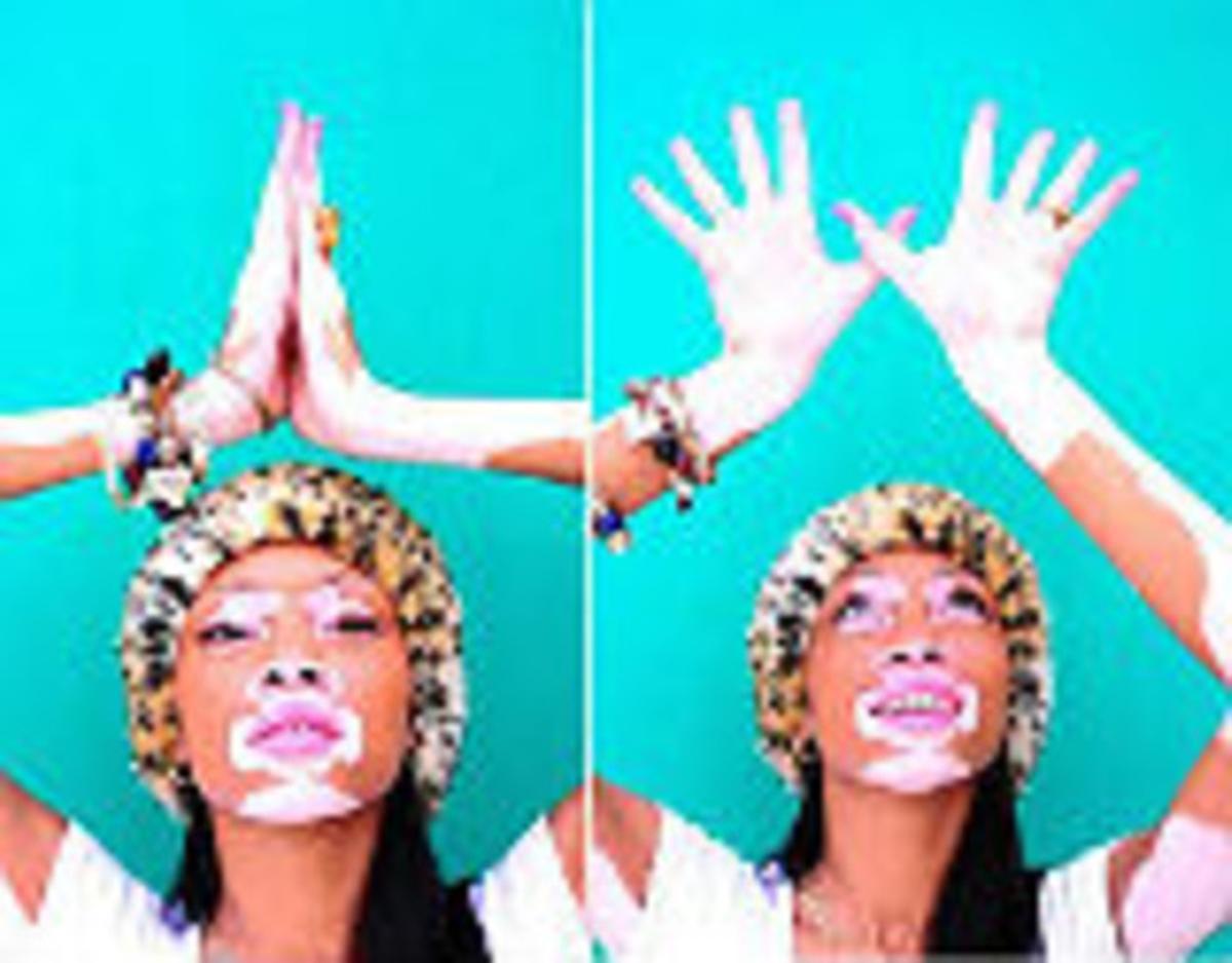 Winnie Harlow.