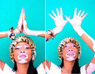 Winnie Harlow, la primera modelo con vitiligo