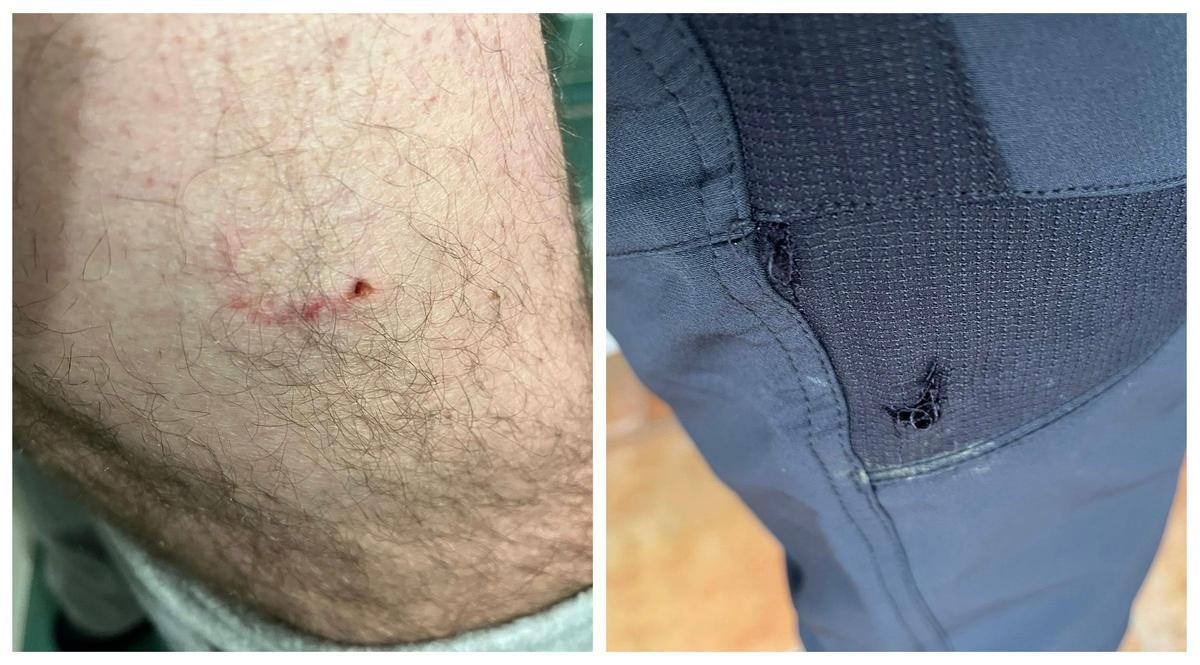 Imágenes compartidas por Pau Sancho de las consecuencias del mordisco del perro este fin de semana.