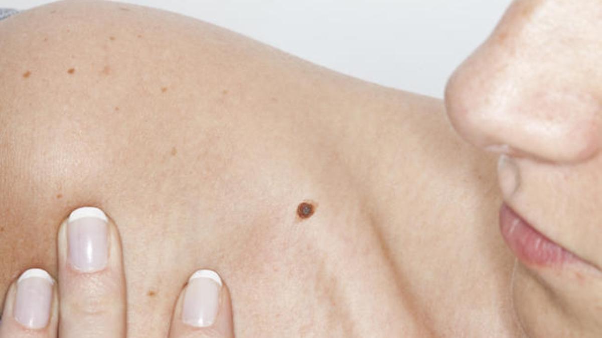 Los lunares, señal de alarma del melanoma.
