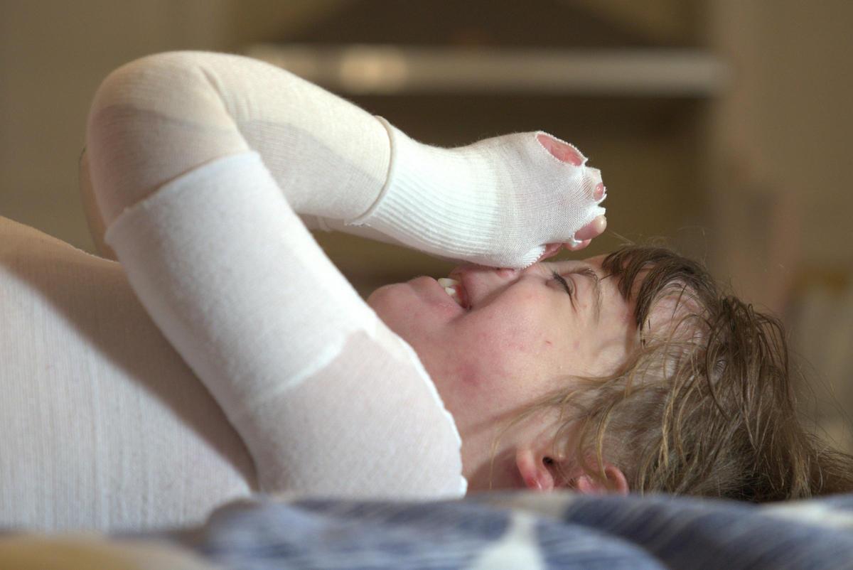 La piel de mariposa suele detectarse a edades tempranas