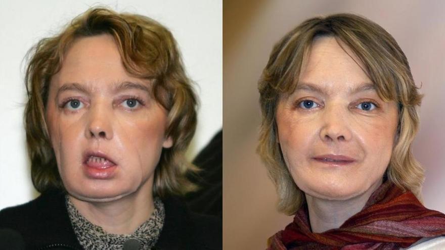 Fallece en Francia la primera mujer a la que se le practicó un trasplante parcial de cara