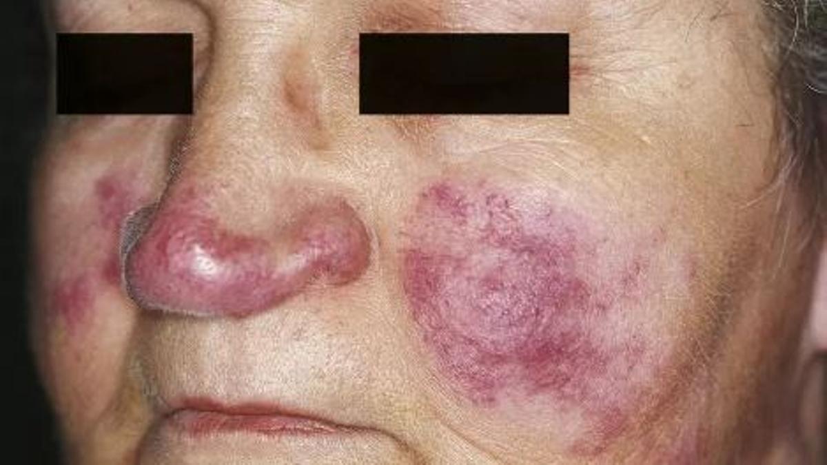 El lupus afecta sobretot dones en edat fèrtil.