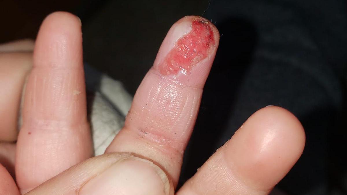 Desgarro en el dedo, del pequeño que ha sufrido un accidente en Plasencia.