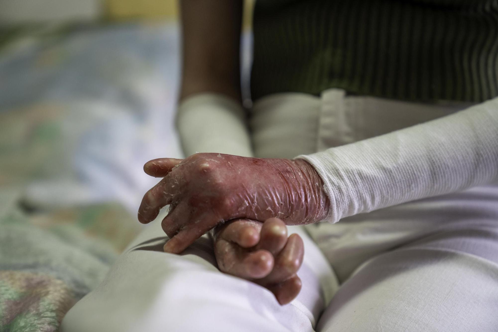 Vivir con piel de mariposa: "El dolor es insoportable"