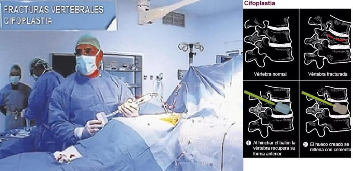 El doctor Vega Curiel realiza la introducción del balón en una cifoplastia.