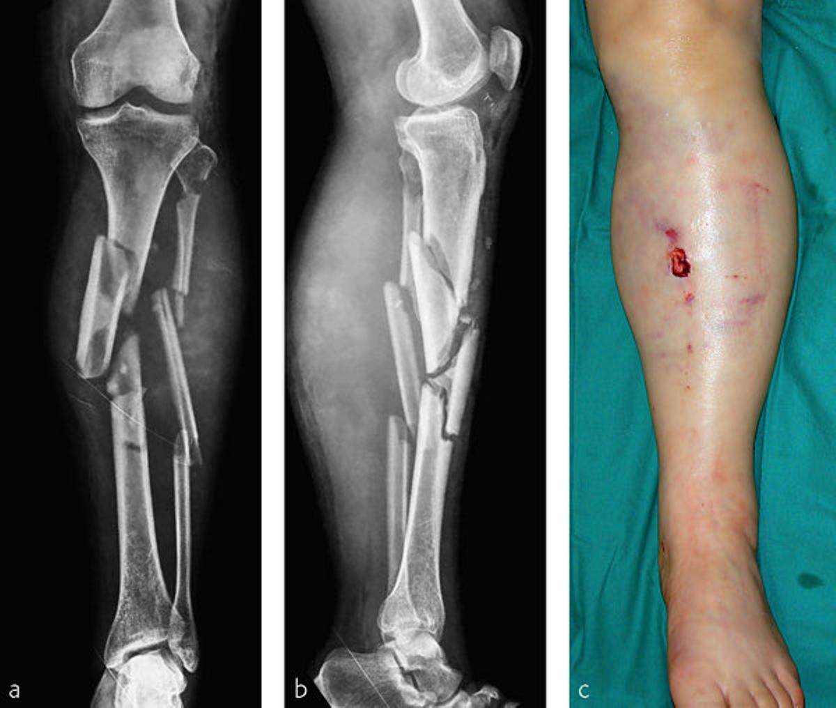 Imagen que explica la situación que atraviesa Lindsey Vonn