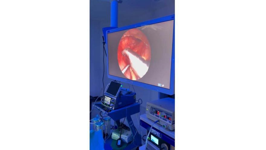 El Hospital Quirónsalud Málaga realiza una compleja cirugía de esófago a un bebé de 24 horas de vida