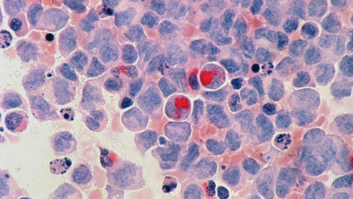 Leucemia mieloide crónica, mieloma y cáncer de colon y recto, entre los que más mejoran.