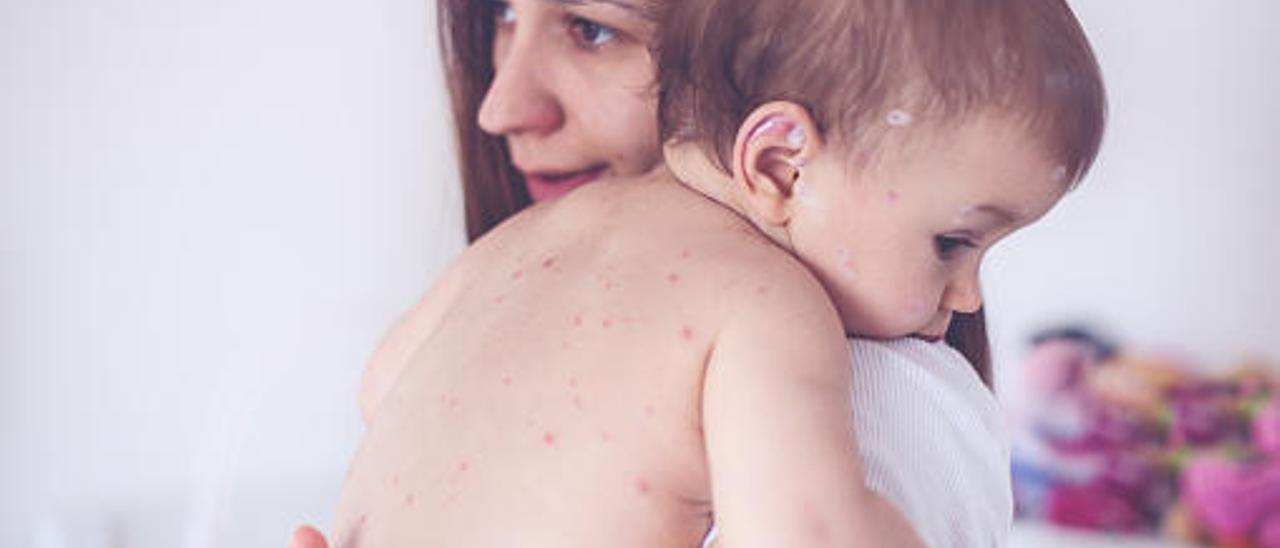 Un bebé con varicela recibe los cuidados de su madre. // iStock