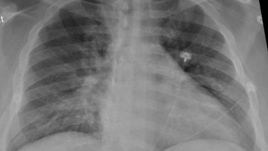 Radiografía de un paciente con daño pulmonar.