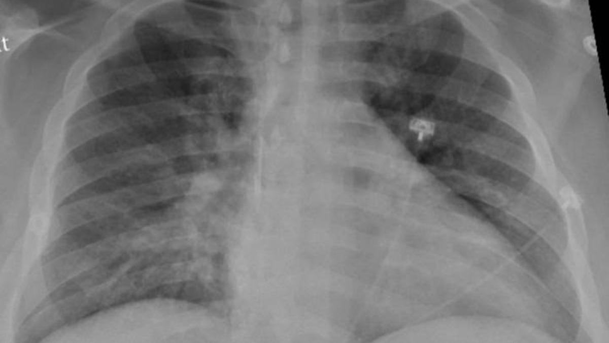 Radiografía de un paciente con daño pulmonar.