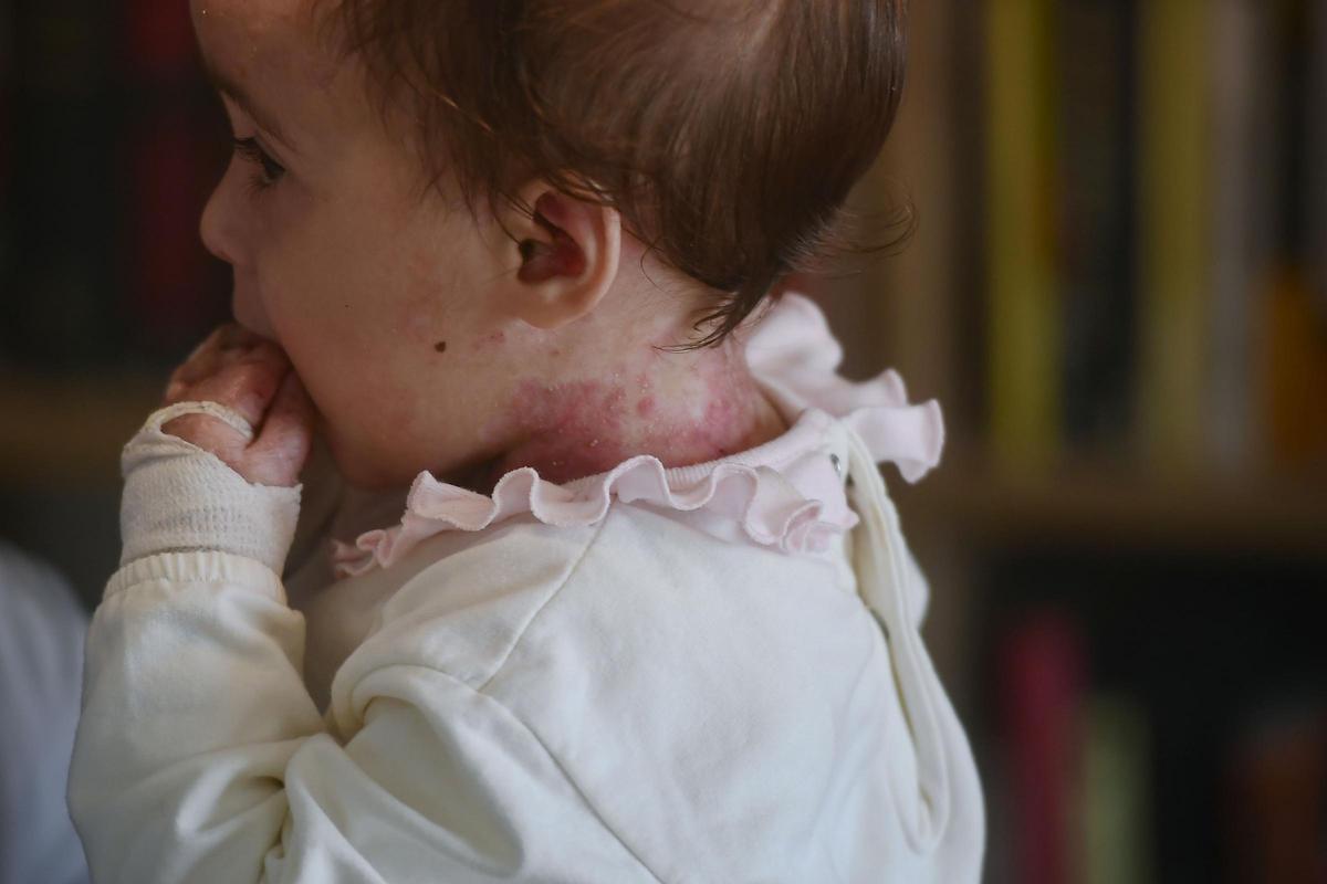 Olivia tiene 'piel de mariposa', una enfermedad rara que provoca que su piel sufra heridas y ampollas incluso con el más leve roce