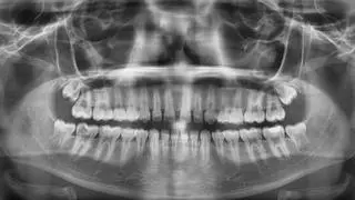 Una nueva inteligencia artificial ayuda a no dejar sin protección a menores migrantes a través de sus radiografías dentales