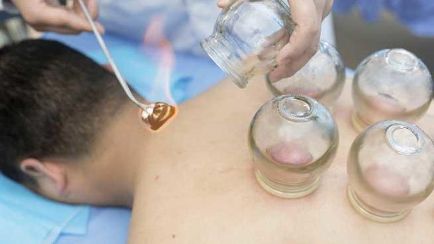 Una fisioterapeuta aplica la técnica del &#039;cupping&#039;.