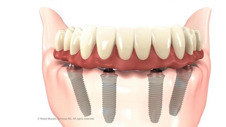 &#039;All-on-4&#039;, dientes fijos desde el primer día