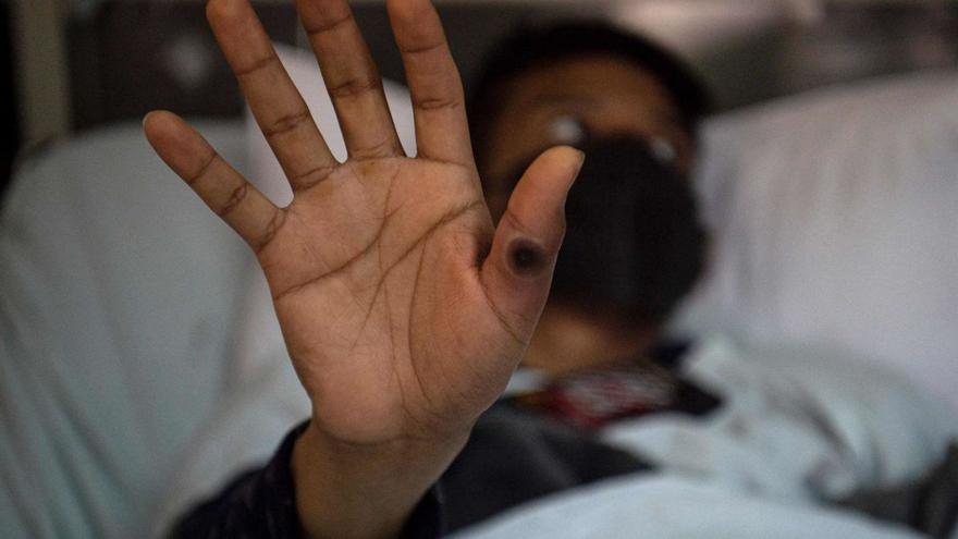 Catalonia rushes to boost monkeypox vaccine