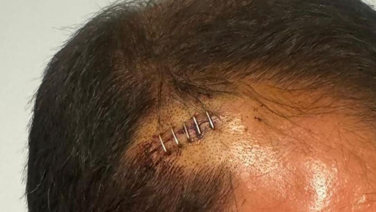 El guardia civil tuvo que recibir grapas de sutura en la cabeza. | EL PERIÓDICO
