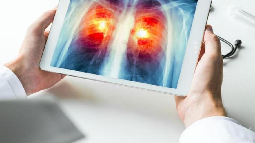 Un médico examina una prueba de imagen de unos pulmones. |   // FARO