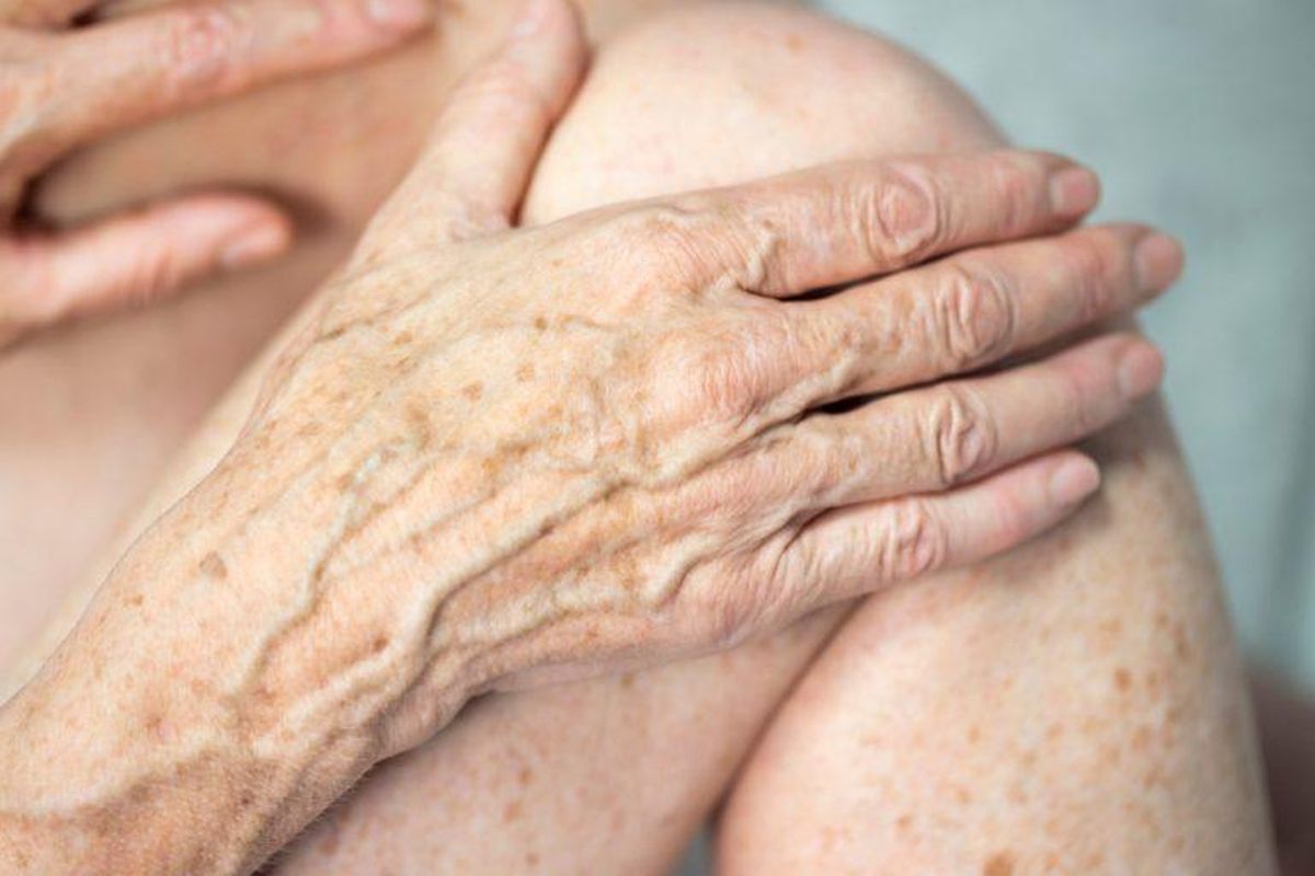Las manchas o léntigos son más grandes que las pecas y comúnmente aparecen en áreas como la cara, manos, brazos, espalda y piernas