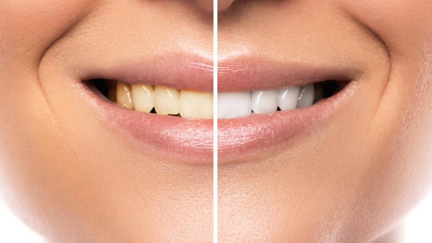 Doctora Patricia Jorro: “En Clínicas Udemax utilizamos un blanqueamiento dental único y que ofrece resultados 100% garantizados”