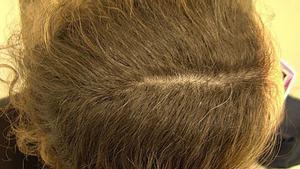 Laura muestra su cuero cabelludo antes y después del tratamiento contra la alopecia areata.