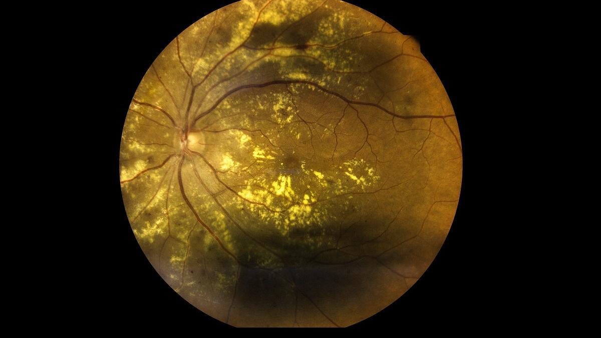 ¿Un nuevo tratamiento para la degeneración macular asociada a la edad?