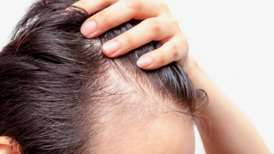 La pérdida de pelo ya no supone un problema con las técnicas de recuperación de cabello