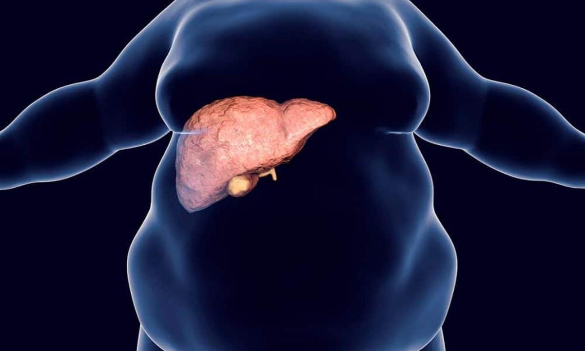 El 20% de las pacientes con hígado graso padecerán esteatohepatitis no alcoholica