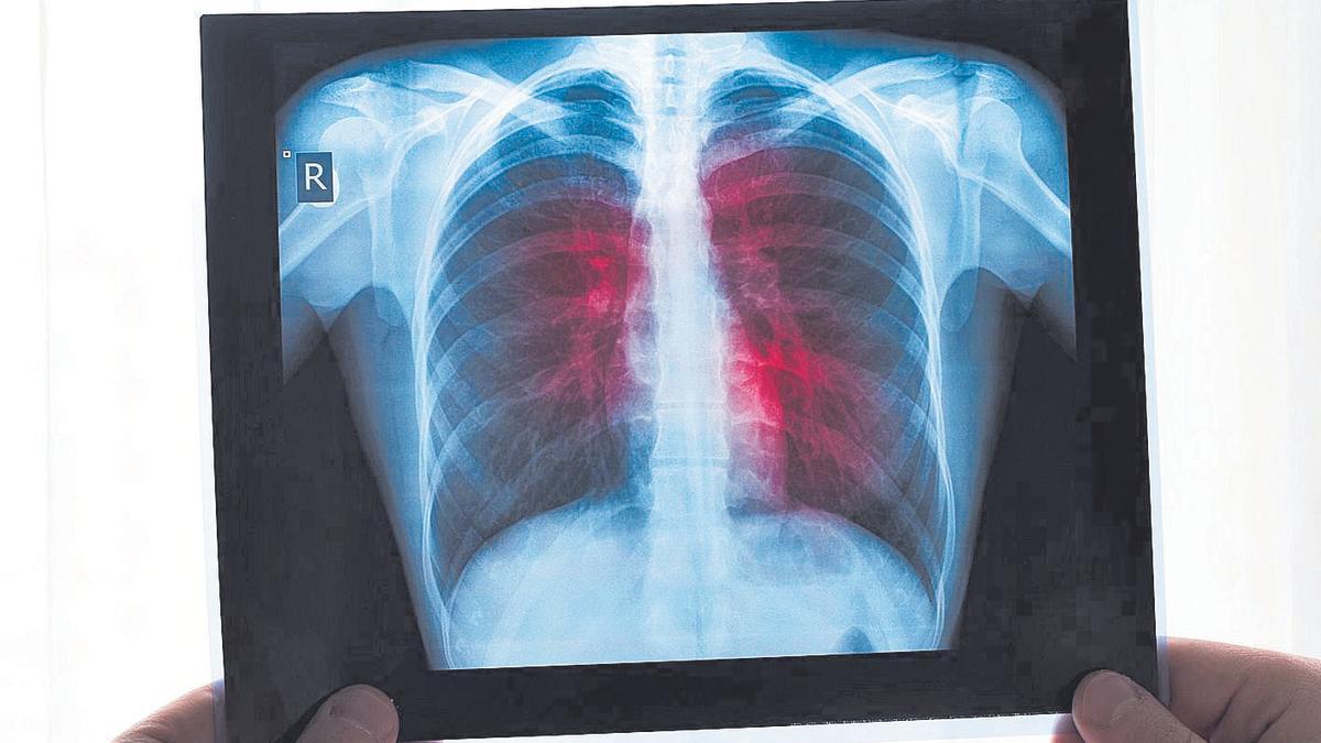 Radiografía de los pulmones