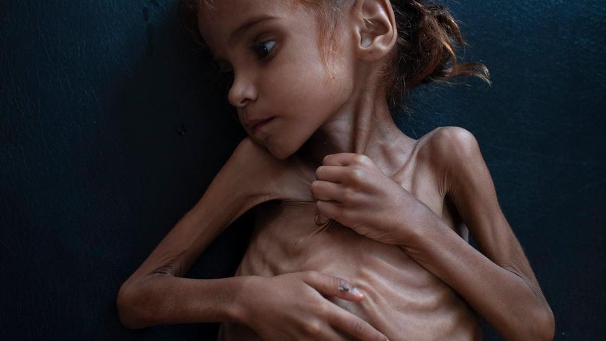 Muere la niña que ilustró las miserias de la guerra en Yemen