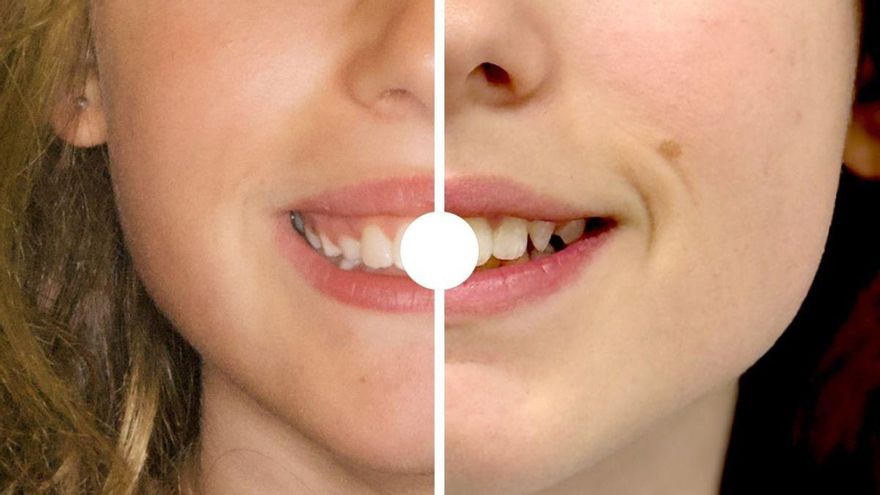 El antes y el después de cinco ilicitanos que decidieron ponerse aparato de dientes