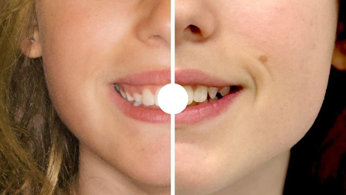 Cinco casos reales, con el antes y después de tratamientos de ortodoncia en IMED Dental.