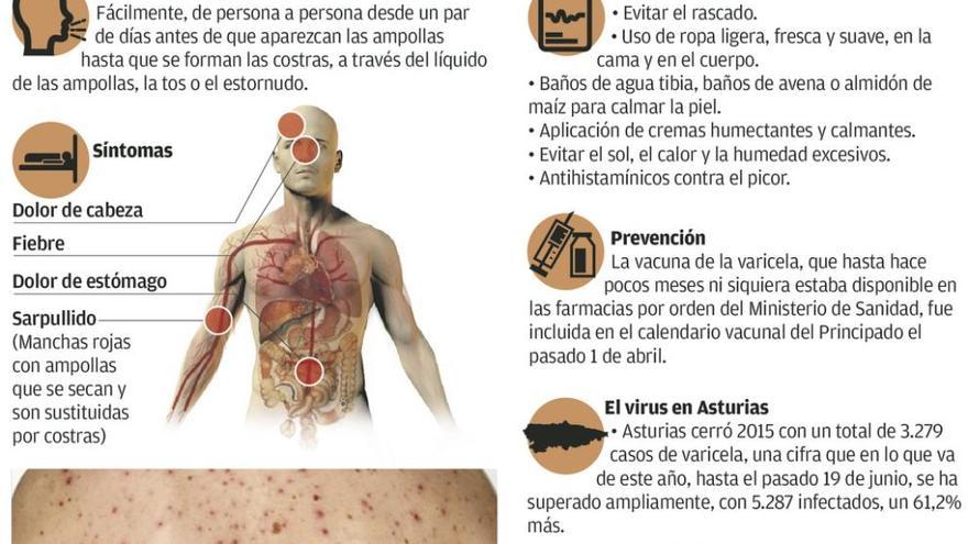 Los casos de varicela se disparan en Asturias, sobre todo en el área de Oviedo