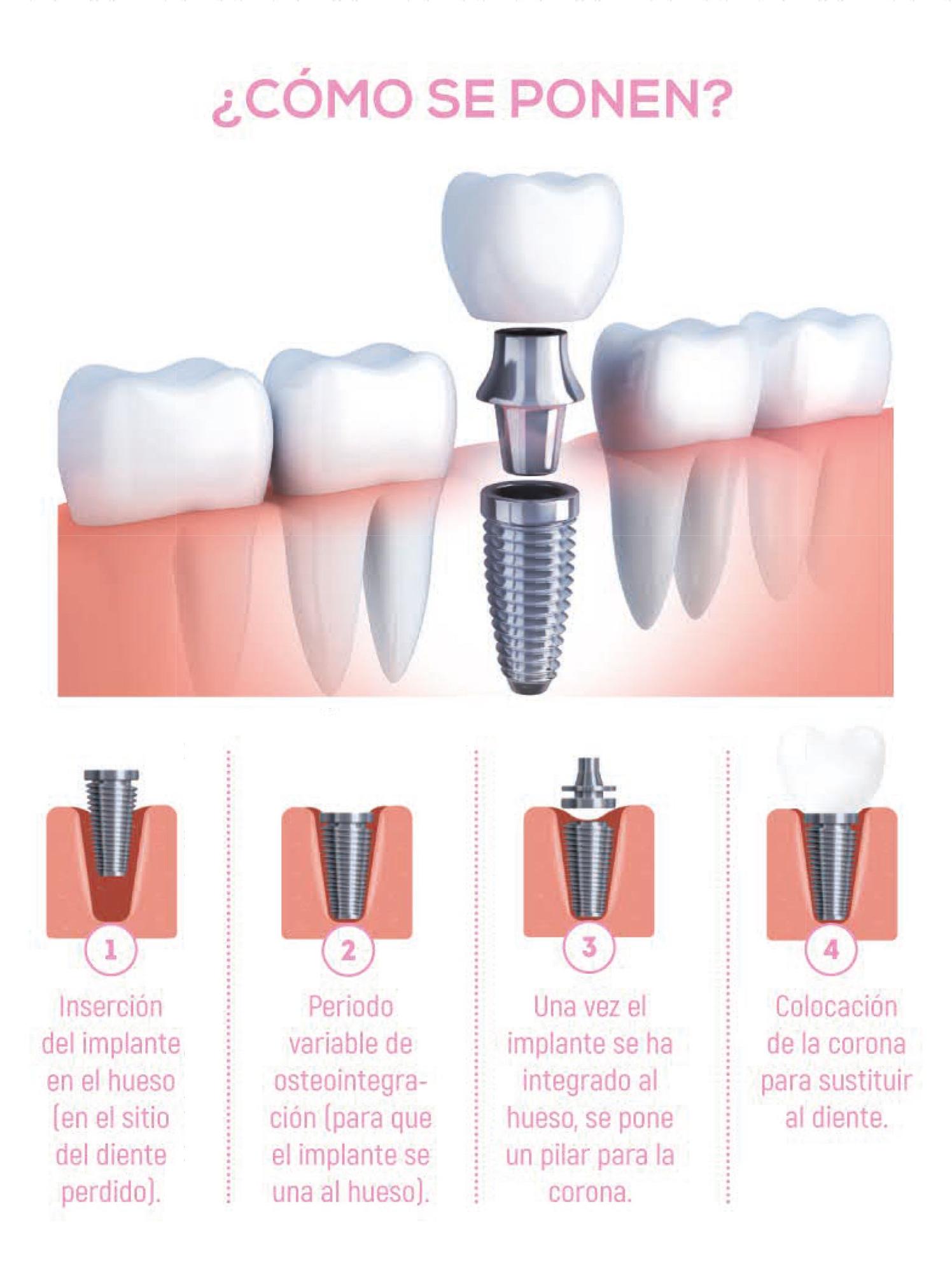 ¿Cómo se componen los implantes?