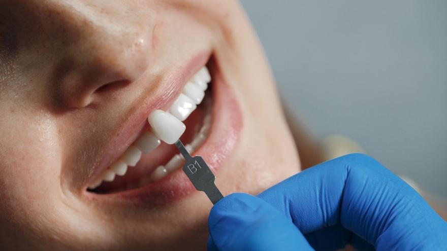 Implantología dental: ¿es la mejor solución para conservar los dientes dañados?
