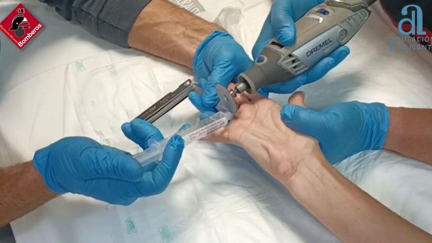 Precisión milimétrica para retirar un anillo &quot;atascado&quot; en el dedo de una mujer en La Vila