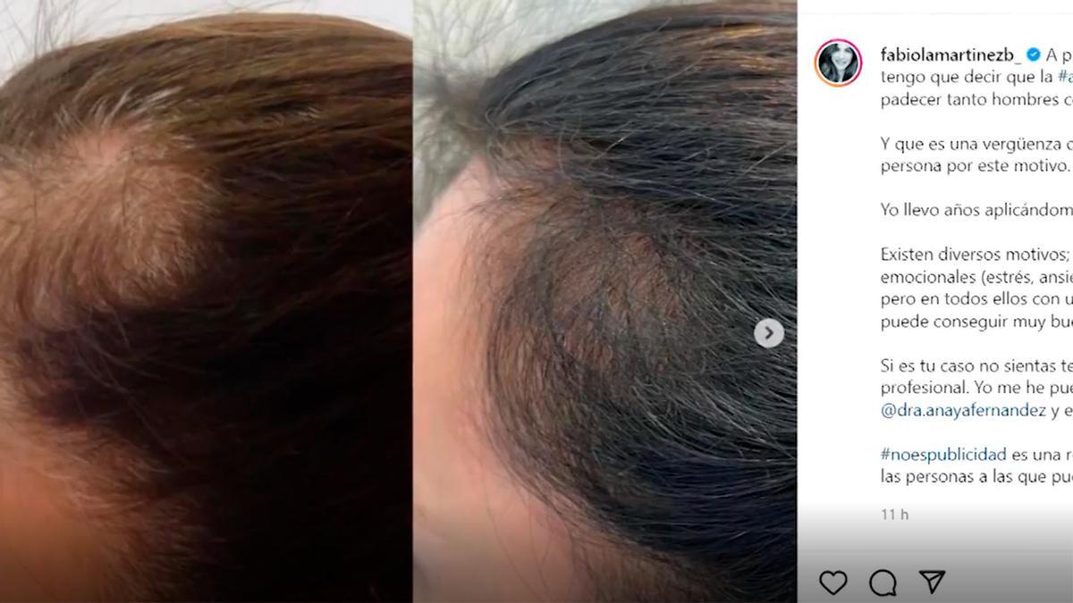 La laca es mala para el pelo?