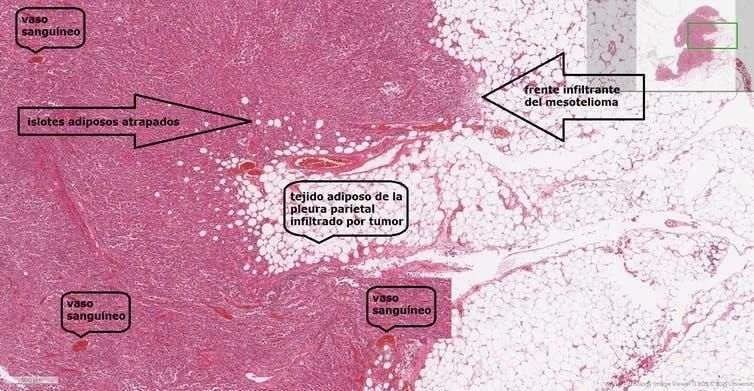Imagen histológica a medianos aumentos de un mesotelioma con elevado grado de anaplasia procedente del microscopio virtual de la Universidad de Leeds.