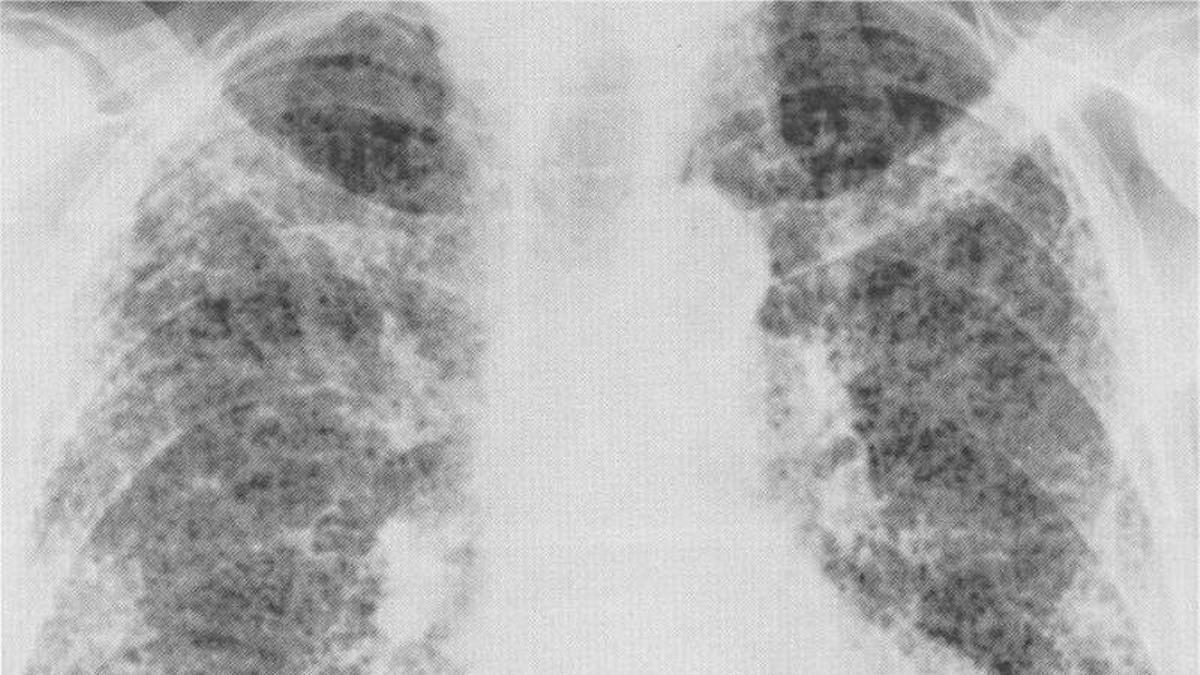 El Hospital de Bellvitge desarrolla una IA que diagnostica con rapidez la fibrosis pulmonar y predice su evolución