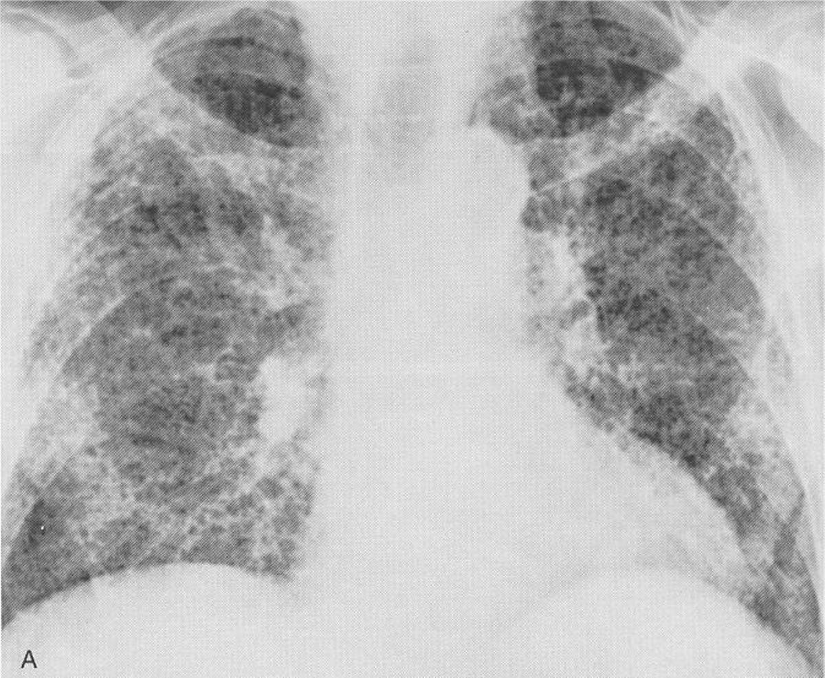 Una radiografía de unos pulmones.