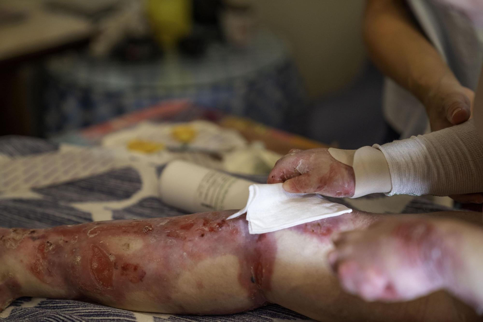 Vivir con piel de mariposa: "El dolor es insoportable"