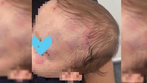 Imagen de los hematomas sufridos por el menor.